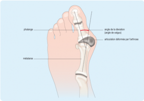 Hallux valgus