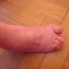 Hallux Valgus