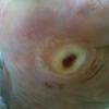 mal perforant plantaire