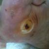 mal perforant plantaire