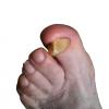 Ongle epais