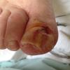 ongle incarné botriomycome