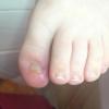 ongle incarné enfant
