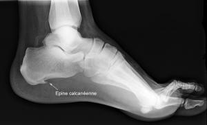 Epine calcaneenne