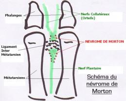 Maladie de morton