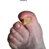 ongle-epais.jpg