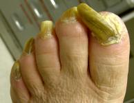 Onychogryphosis1