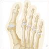 pied-hallux-valgus-2.jpg