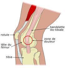 Syndrome essuie glace